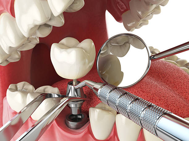 Best Emergency Dental Extractions in Brentwood, MO