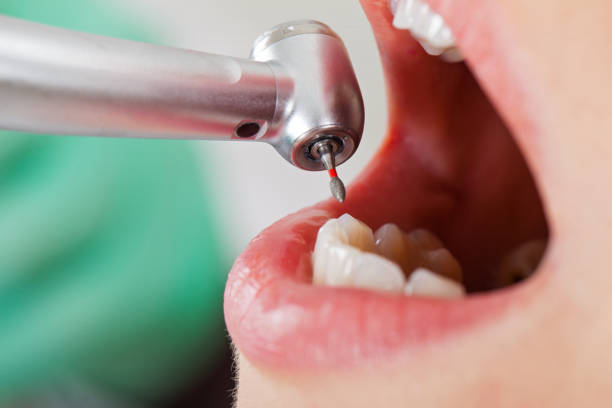 Best Emergency Root Canal Treatment in Brentwood, MO